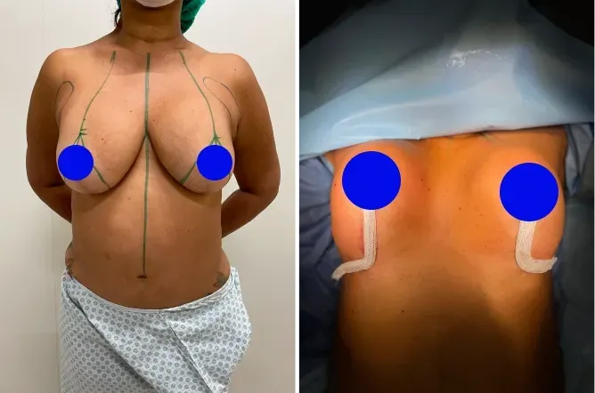 Antes e depois de cirurgia plástica no Rio de Janeiro — Dr. Alexandre Charão