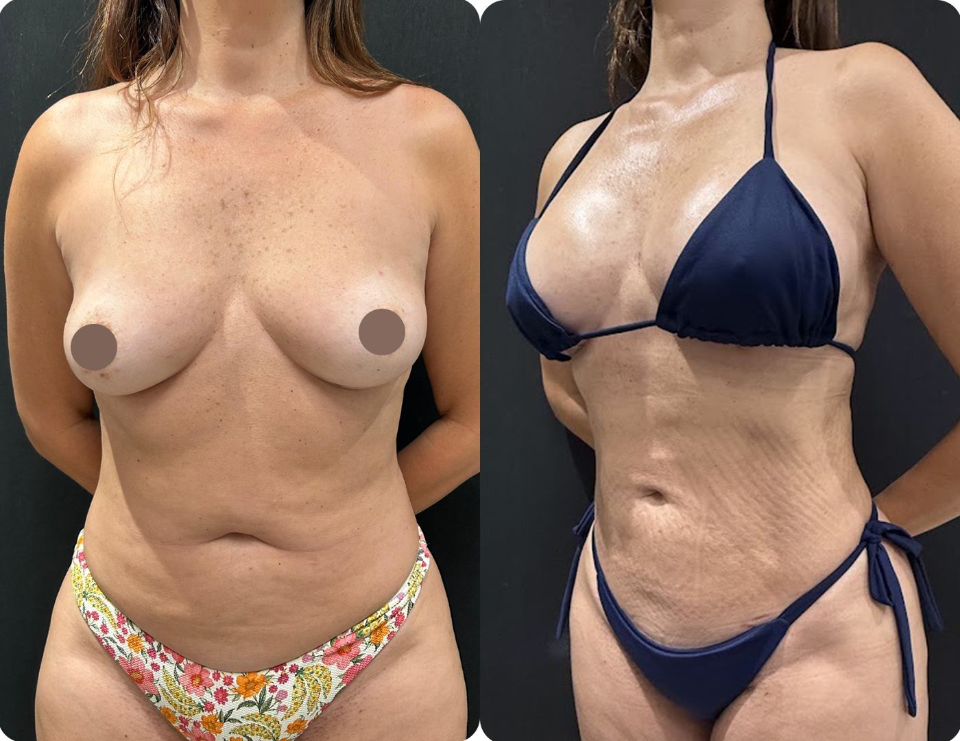 Resultado Mommy Makeover 3