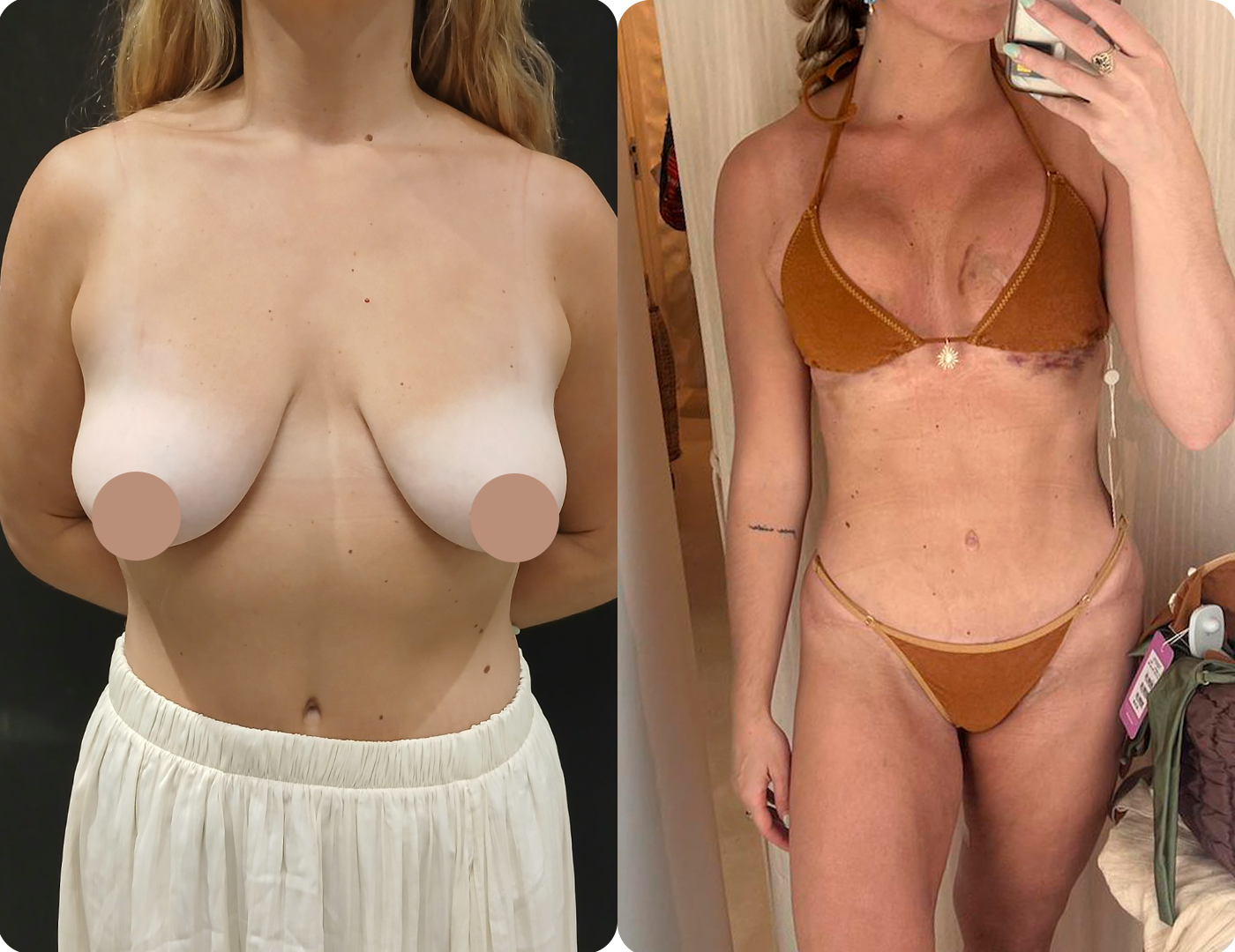 Resultado Mommy Makeover 1
